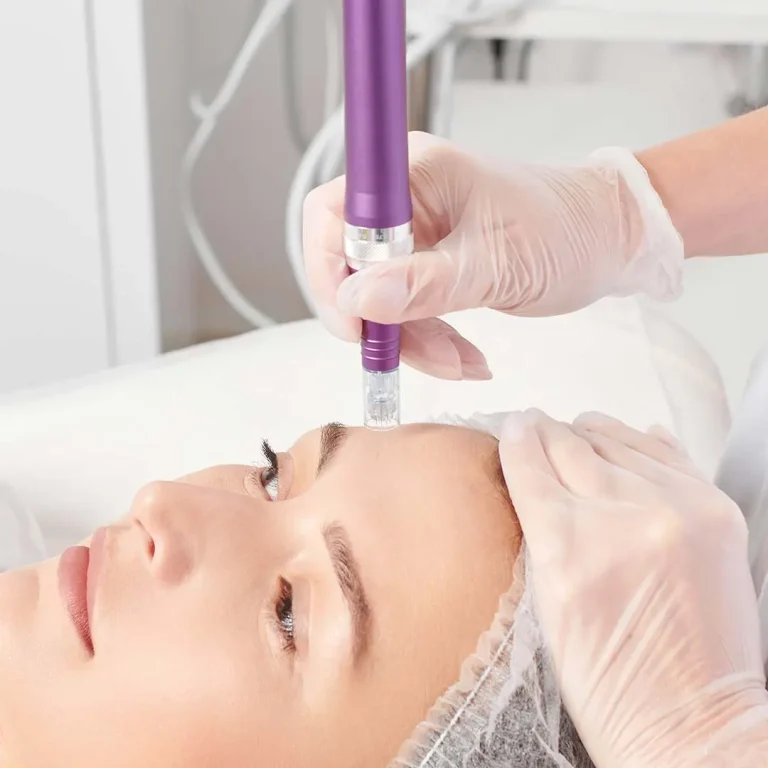Micro-Needling
